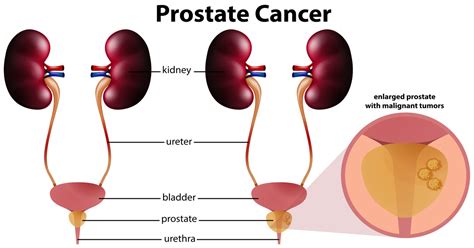 Enlarged Prostate How One Can Treat It