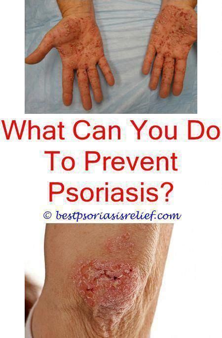 Psoriasistreatmentnew Freepoledancingclassesnyc Natural Psoriasis