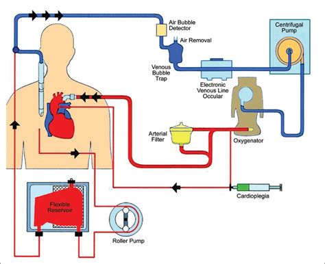 The cardiopulmonary bypass machine and how it works the cpb is the machine that allows surgeons to operate on a nonmoving, bloodless heart. Mini cardiopulmonary bypass: Anesthetic considerations ...