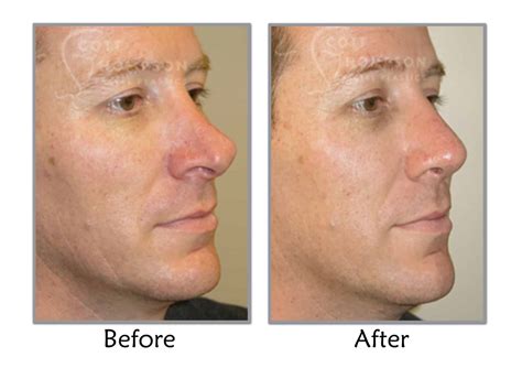 Deviated Septum Repair In Utah Functional Nasal Surgery