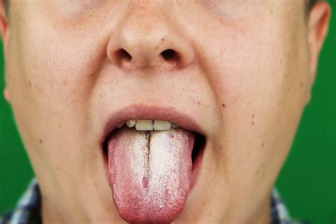 갈라진 혀 또는 균열설 원인과 치료