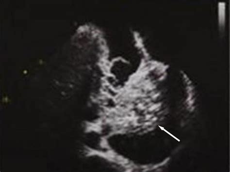 Isolated Tricuspid Valve Infective Endocarditis In Young Drug Abusers