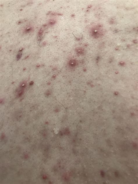 Acne I Have Had Acne My Whole Life And I Just Want To Get Rid Of It