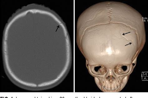 [pdf] Pediatric Skull Fracture Diagnosis Should 3d Ct Reconstructions Be Added As Routine