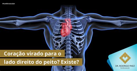 coração virado para o lado direito do peito existe dr rodrigo paez cardiovascular