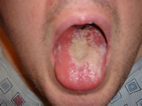 Thrush Mouth Infection Xxx Porn Library