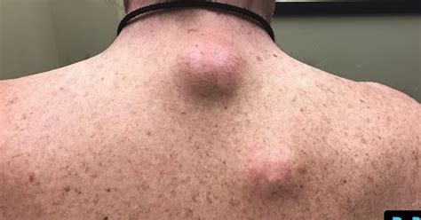 Dr Pimple Popper Harvests More Onion Cysts From The Back Of A Very