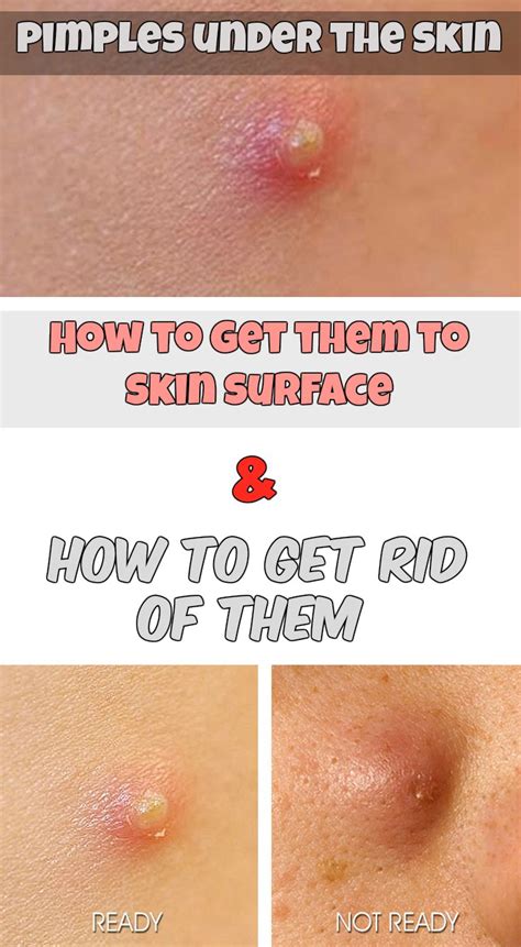This is pretty important for people who want to know how to get rid of deep acne scars: Pimples under the skin - How to get them to skin surface ...