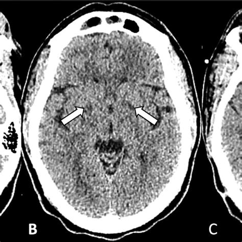 Noncontrast Computed Tomography Images Of The Head From The Patient At