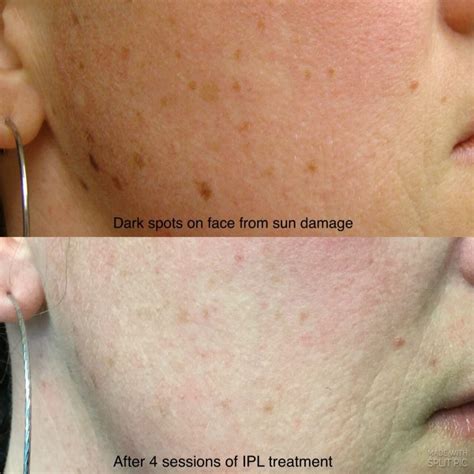 Ipl Photofacials Treatment What It Is And How It Works