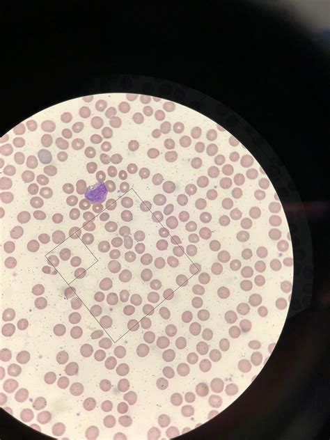 Peripheral Blood Smear What Type Of Cell Is This