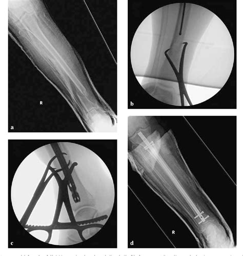 Intramedullary Nailing Of Proximal Tibial Fractures