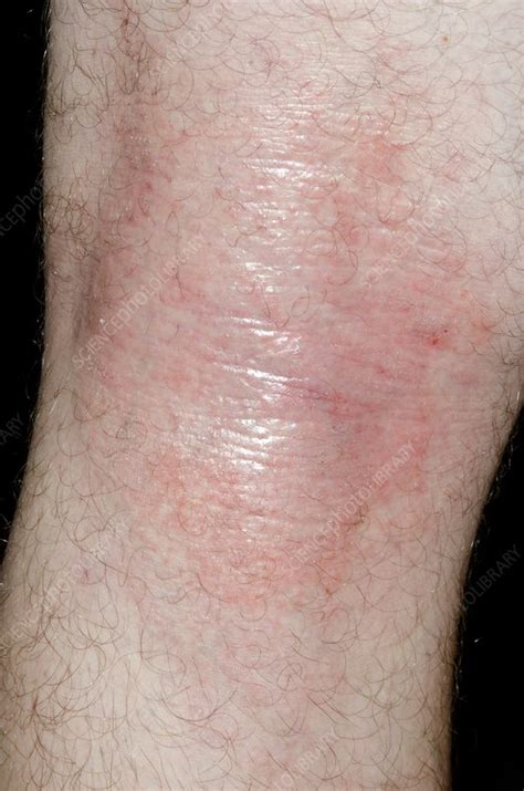Atopic Eczema Behind The Knee Stock Image C0167248 Science Photo