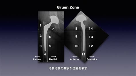 整形外科のいろいろ On Twitter Thaやbhaにおいてはgruen Zoneは覚えておくと良いかもしれません。 ステム周囲の場所