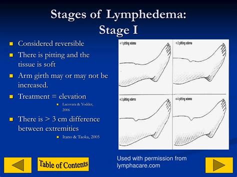 Ppt Lymphedema Powerpoint Presentation Free Download Id1272891