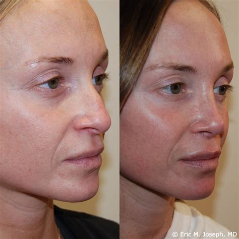 Eric M Joseph Md Rhinoplasty Before After Septoplasty And Hump Removal