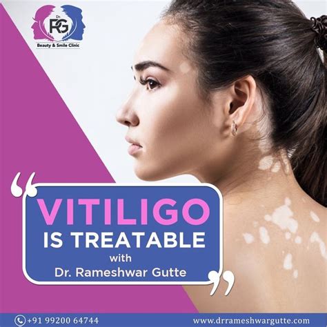 Vitiligo Vitiligo Vitiligo Treatment Vitiligo Cure