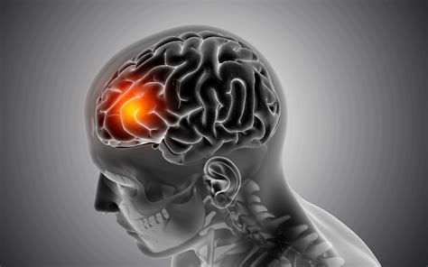 ¿cómo Identificar Los Síntomas De Un Accidente Cerebrovascular Y Qué