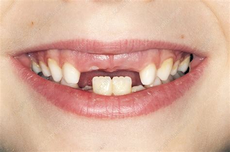 Normal Tooth Loss Stock Image C0117375 Science Photo Library