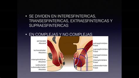 Absceso Y Fistula Anorectoperianal Youtube