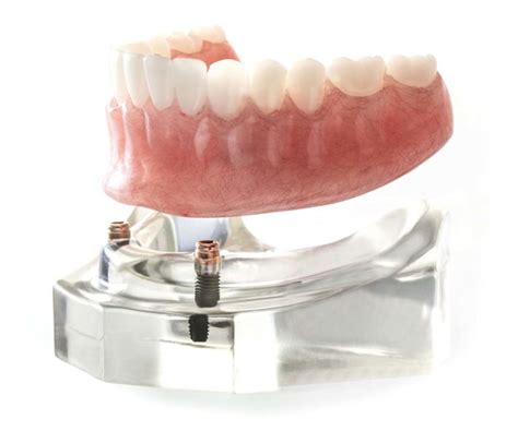 Implant Supported Dentures Edmonton South Centre Denture Clinic