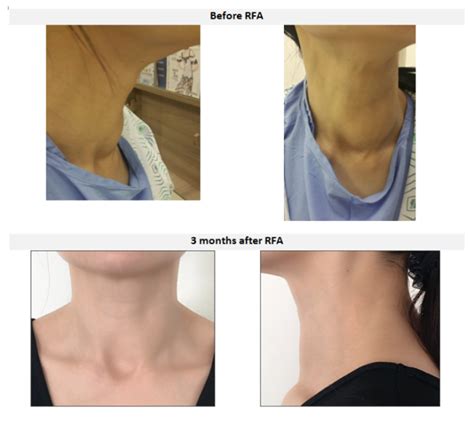 Non Surgical Therapies For Thyroid Nodules And Cysts Thyroid Patients