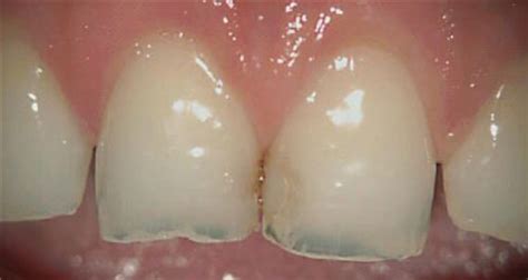 How Do Dentist Fix Cavities Between Teeth Teeth Poster