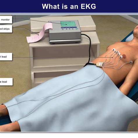 What Is An Ekg Trialexhibits Inc
