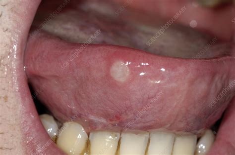 Aphthous Ulcer On The Tongue Stock Image C0051857 Science Photo