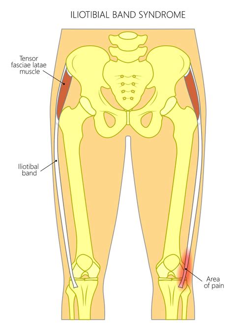 Iliotibial Band Syndrome Runners Knee Complete Physio