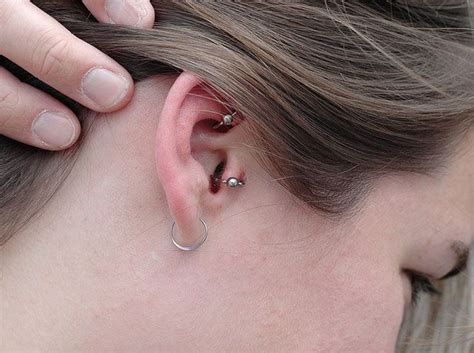 Infected Ear Lobe Piercing Abscess