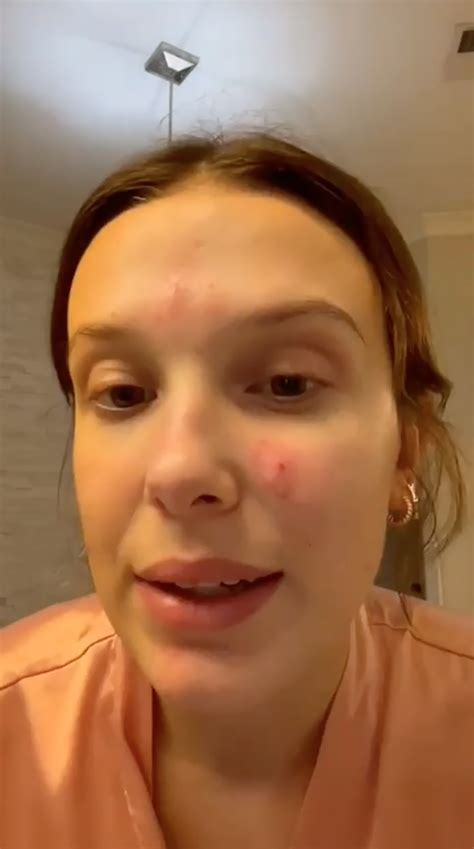 Millie Bobby Brown Gets Candid About Her Acne Embracing The