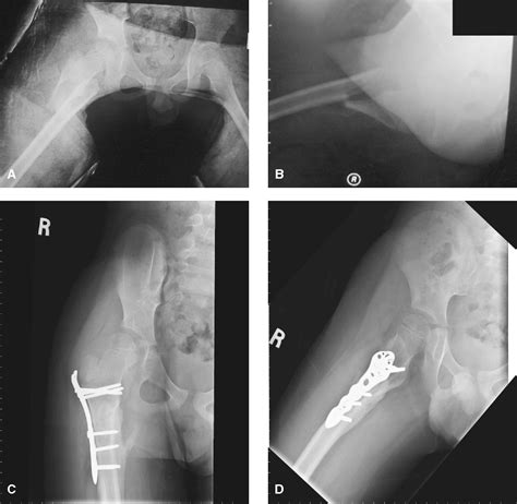 Figure 2 From Adult Periarticular Locking Plates For The Treatment Of