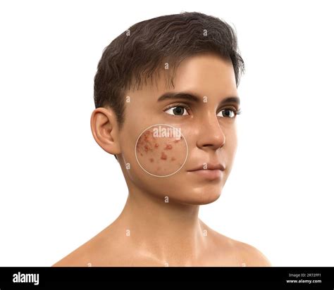 Acne Vulgaris On A Teenage Boys Face Computer Illustration Showing