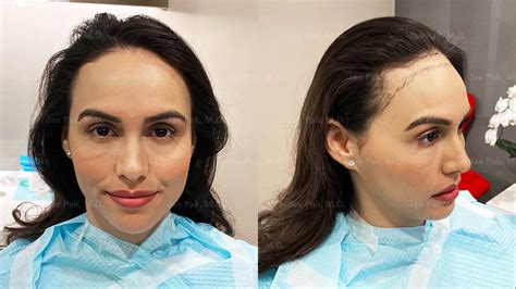 Models Hairline Lowering Before And After Jae Pak Md Medical