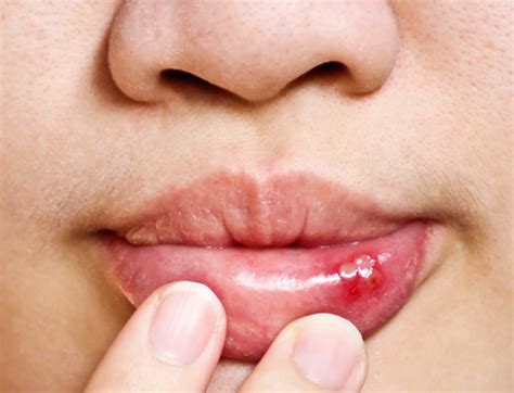 Dental Health And Canker Sores