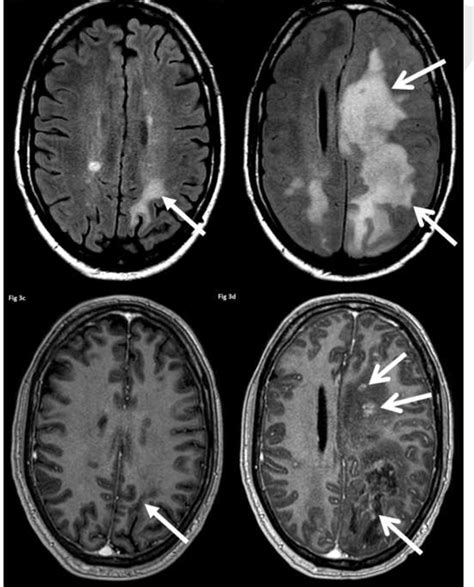 Typical Imaging Features Of Multiple Sclerosis With C