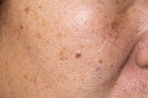 What Is Melasma Treatment Causes