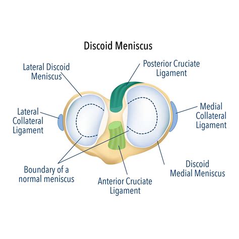 Discoid Meniscus Surgery Discoid Meniscus Treatment
