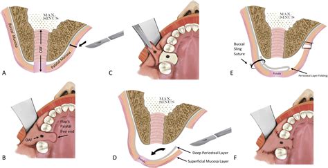 A Pedicled Palatal Periosteal Flap For The Closure Of Oro Antral