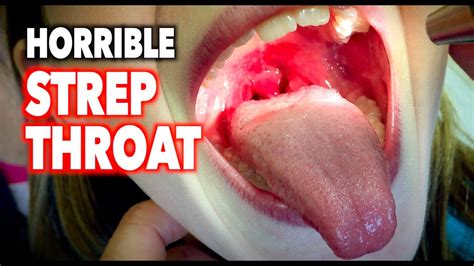 strep throat tonsils