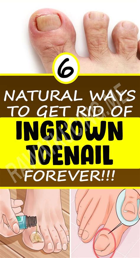 Treat Your Ingrown Toenail With These 6 Natural And Homemade Remedies
