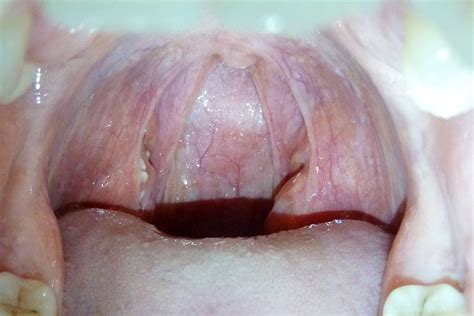 Natural Remedies For Swollen Tonsils