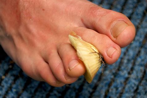 Bee Sting Toe Flickr Photo Sharing