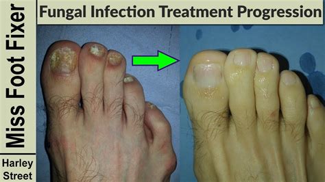 Nail Treatment Progression Photo Before And After By Fungal Nail Expert