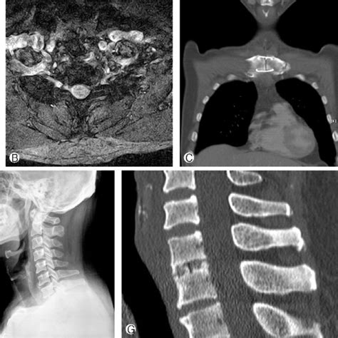 Clinical Characteristics Of The Patients With C7 T1 Disc Herniation