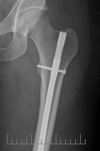 From accidentally running over your rod to closing the door of your trunk on it, there are quite a few instances that could lead to your rod's destruction. The Broken Bone/Xray Thread