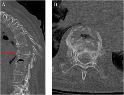 Computed Tomography Images Of The T9 Burst Fracture With Retropulsion