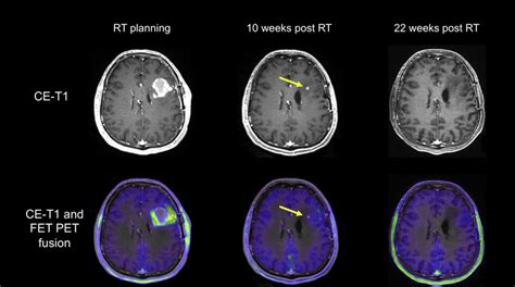 Patient With A Newly Diagnosed Glioblastoma After Resection And