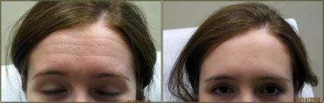 Dr Tricia Brown Dermatologist In Houston Tx Before And After Botox